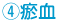 瘀血