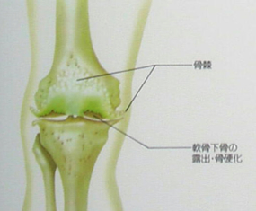 変形性膝関節症の状態像