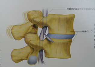 腰椎分離症側面像