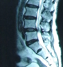 腰部脊柱管狭窄症のMRI
