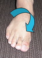 （外反捻挫）